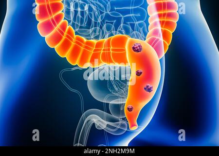 Rectum ou cancer colorectal avec des organes et des cellules cancéreuses 3D en montrant l'illustration avec le corps masculin. Anatomie, oncologie, maladies des intestins ou des entrailles, Banque D'Images