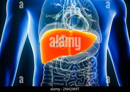 Cancer du foie avec des organes et des tumeurs ou des cellules cancéreuses 3D illustration du rendu. Anatomie, oncologie, biomédical, maladie, médical, biologie, science, h Banque D'Images