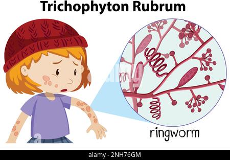 Illustration de l'infection fongique de Trichophyton rubrum Illustration de Vecteur