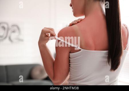 Femme avec une peau brûlée de soleil à la maison, gros plan Banque D'Images