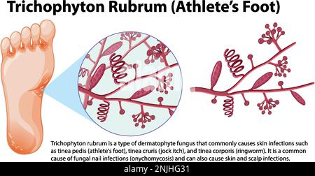 Illustration de l'infection fongique de Trichophyton rubrum Illustration de Vecteur