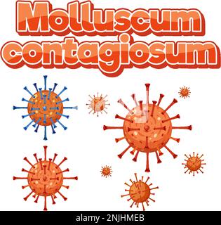 Virus de la maladie de Moluskum contagiosum sur fond blanc illustration Illustration de Vecteur