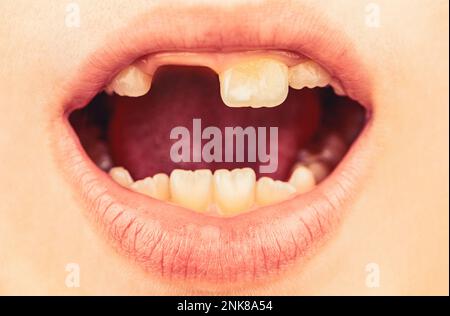 Mauvais dents enfant. Portrait garçon avec de mauvaises dents. Gros plan sur les téths malsains de bébé. Patient enfant, bouche ouverte montrant des caries, carie dentaire Banque D'Images