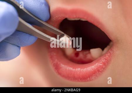 Retrait d'une dent de lait. Le médecin a tiré une dent d'un enfant avec une pince à épiler. Extraction de la dent d'un enfant à l'aide d'un instrument dentaire. Banque D'Images