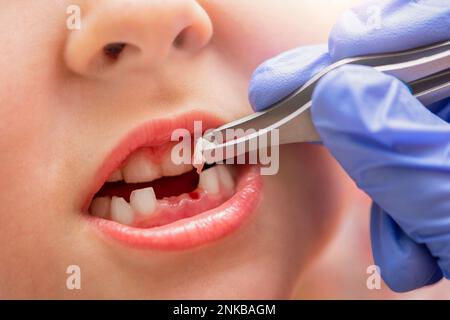 Retrait d'une dent de lait. Le médecin a tiré une dent d'un enfant avec une pince à épiler. Extraction de la dent d'un enfant à l'aide d'un instrument dentaire. Banque D'Images