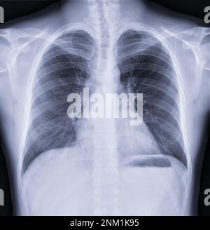 Image radiologique du thorax , thorax normal. Banque D'Images