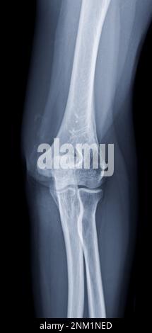 Rayons X de la jonction de coude montrant la jonction de coude normale. Banque D'Images