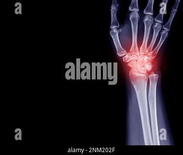 Image radiographique de l'articulation du poignet vue avant de l'articulation du poignet normale. Banque D'Images