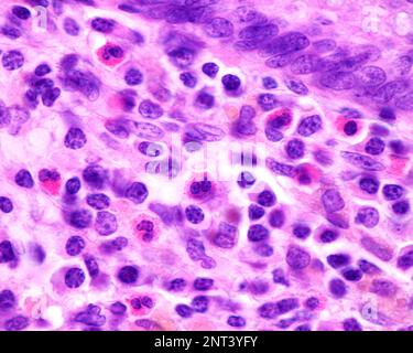 Micrographe au microscope léger montrant les granulocytes éosinophiles dans la lamina propria d'un appendice enflammé. Ces cellules contiennent des granules rouges abondants ( Banque D'Images