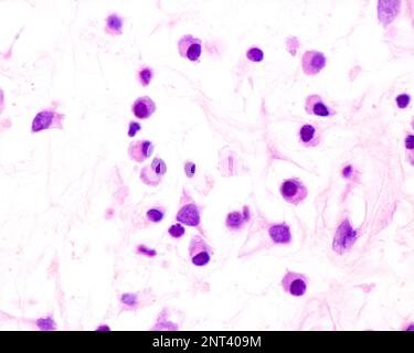Les cellules plasmatiques sont des lymphocytes B activés par la présence d'antigènes qui sécrètent de grandes quantités d'anticorps. Ils apparaissent dans les tissus affectés par c Banque D'Images