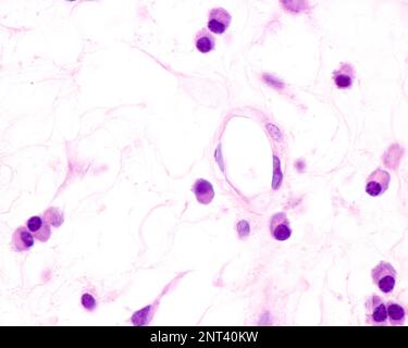 Les cellules plasmatiques sont des lymphocytes B activés par la présence d'antigènes qui sécrètent de grandes quantités d'anticorps. Ils apparaissent dans les tissus affectés par c Banque D'Images