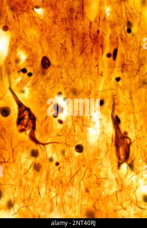 Micrographe léger d'un cortex cérébral humain montrant des enchevêtrements neurofibrillaires dans deux neurones pyramidaux. Les enchevêtrements neurofibrillaires (TNF) sont caractéristiques Banque D'Images