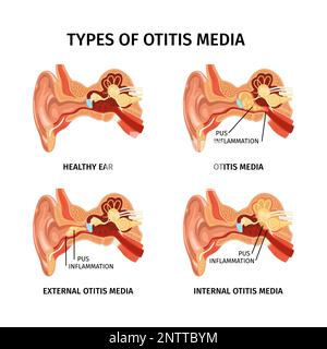 Otite anatomique réaliste ensemble de quatre diagrammes anatomiques isolés avec légendes de texte et illustration du vecteur des organes internes Illustration de Vecteur
