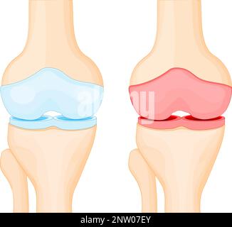 Articulation saine et arthrose du genou. comparaison. Le cartilage bleu est normal, et l'articulation rouge est inflammation. Poster vectoriel Illustration de Vecteur