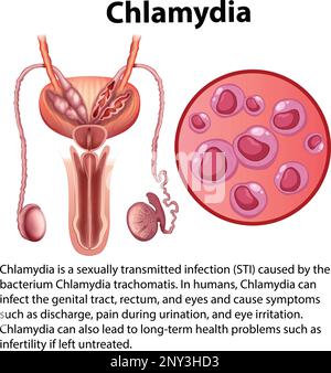 Chlamydia trachomatis avec illustration explicative Illustration de Vecteur