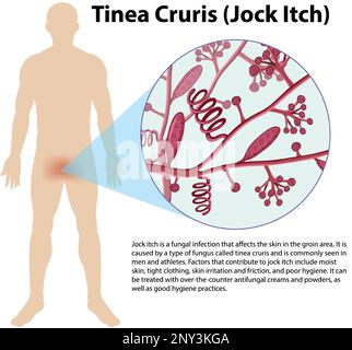 Illustration de l'infection fongique de Trichophyton rubrum Illustration de Vecteur