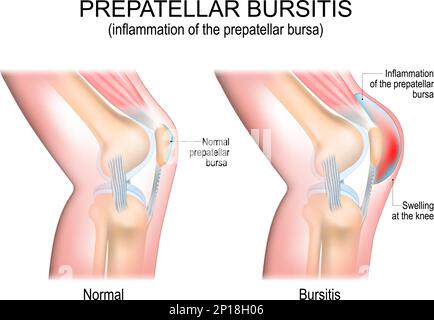 Bursite prépatellaire. inflammation de la bursa prépatellaire. Comparaison d'un genou humain avec une bursa prépatellaire normale et une articulation avec une bursite. vecteur Illustration de Vecteur