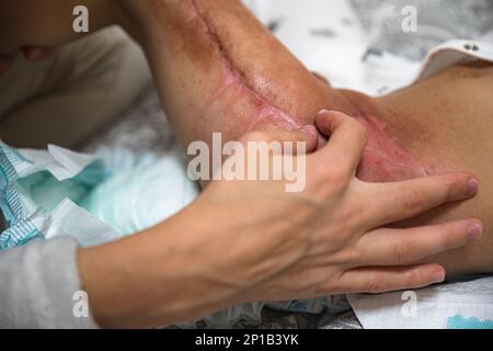 Zone brûlée sur la jambe après radiothérapie, chirurgie pour enlever la tumeur cancéreuse Banque D'Images