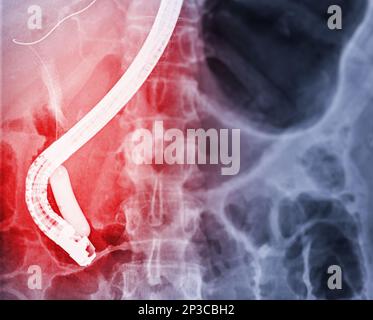 Image radiographique de l'endoscopie après Doctor Doing ERCP et cholécystectomie laparoscopique à l'intérieur de la salle d'opération moderne. Banque D'Images