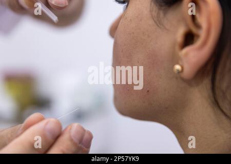 Traitement de l'aiguille sèche. Un portrait d'une petite aiguille d'acupuncture qui colle dans le visage d'une personne à côté du nez, pour guérir la douleur, soulager le stress ou un autre M. Banque D'Images