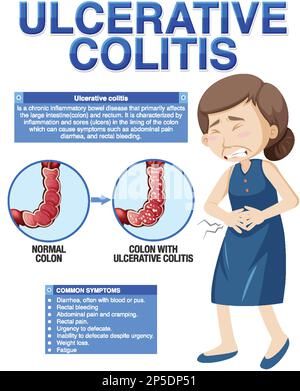 Illustration infographique des symptômes de la colite ulcéreuse Illustration de Vecteur