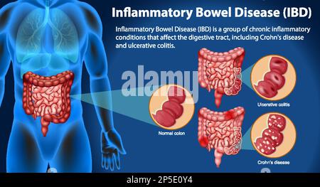 Illustration infographique des maladies inflammatoires de l'intestin (MII) Illustration de Vecteur