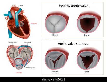 Sténose valvulaire aortique ou aortique saine. Type de cardiopathie valvulaire ou valvulaire. Illustration de Vecteur