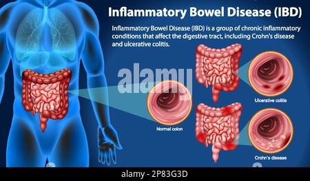 Illustration infographique des maladies inflammatoires de l'intestin (MII) Illustration de Vecteur