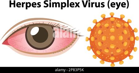 Illustration du virus de l'herpès simplex (œil) Illustration de Vecteur