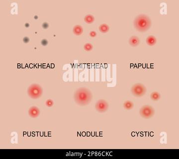 Différents types d'acné. Types de peau d'acné. Têtes noires, têtes blanches, papules, pustules, kystiques et nodulaires. Problèmes de soins de la peau et inflammation. Illustration de Vecteur