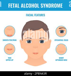 Syndrome d'alcoolisme foetal caractéristiques faciales chez un enfant Illustration de Vecteur