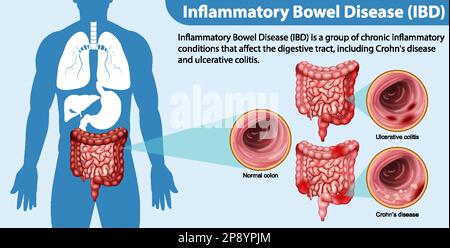 Illustration infographique des maladies inflammatoires de l'intestin (MII) Illustration de Vecteur