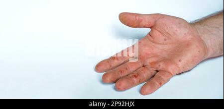 Mains de sexe masculin avec éruption de Monkeypox. Patient atteint de la maladie virale de Monkeypox. Gros plan d'une éruption cutanée douloureuse, des taches rouges apparaissent sur la peau. Palmier humain et santé Banque D'Images
