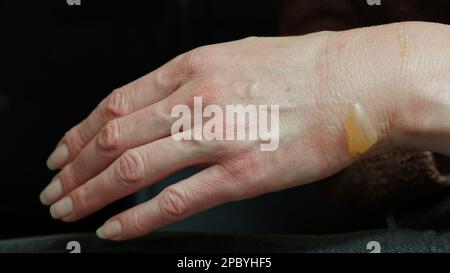 Gros plan de la main d'une femme avec une boursouflure provenant d'une brûlure à l'eau bouillie, d'une brûlure de 1st ou deuxième degré. Plaie douloureuse. Brûlure thermique. Eau bladde Banque D'Images