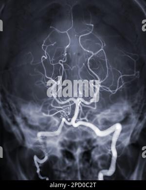 Angiographie cérébrale image ou artère cérébrale potertérior de scopie en radiologie d'intervention montrant l'artère basilaire. Banque D'Images