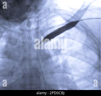Image de l'angioplastie, de l'angioplastie par ballonnet et de l'angioplastie transluminale percutanée (PTA) . Banque D'Images