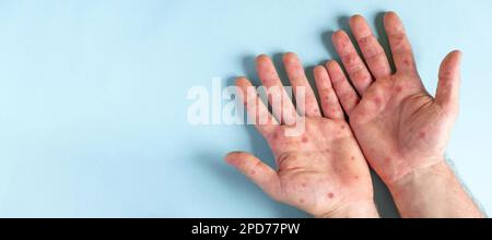 Mains de sexe masculin avec éruption de Monkeypox. Patient atteint de la maladie virale de Monkeypox. Gros plan d'une éruption cutanée douloureuse, des taches rouges apparaissent sur la peau. Palmier humain et santé Banque D'Images
