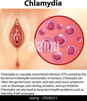 Chlamydia trachomatis avec illustration explicative Illustration de Vecteur