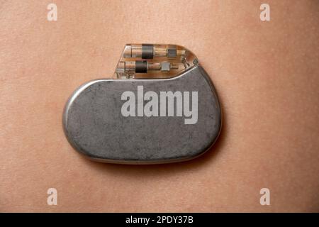 stimulateur cardiaque sur la surface de la peau Banque D'Images