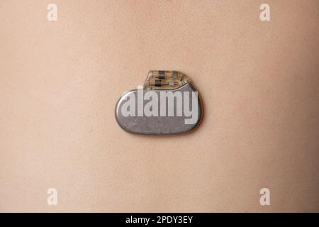 stimulateur cardiaque sur la surface de la peau Banque D'Images