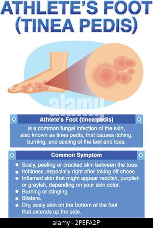 Affiche informative sur l'illustration du pied de l'athlète Illustration de Vecteur