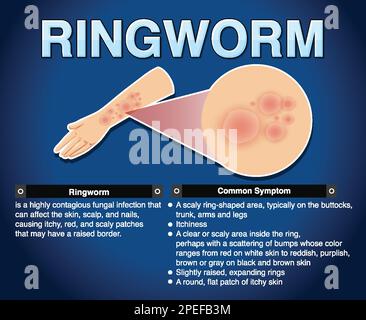 Affiche informative sur l'illustration de la teigne tonsurante Illustration de Vecteur