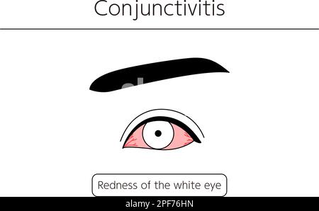 Medical Clipart, Line Drawing Illustration of Eye Disease and conjonctivite, Vector Illustration Illustration de Vecteur