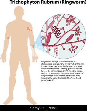 Illustration de l'infection fongique de Trichophyton rubrum Illustration de Vecteur