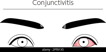 Medical Clipart, Line Drawing Illustration of Eye Disease and conjonctivite, Vector Illustration Illustration de Vecteur