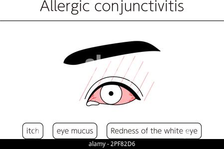 Medical Clipart, Line Drawing Illustration of Eye Disease and allergique conjonctivite, Vector Illustration Illustration de Vecteur