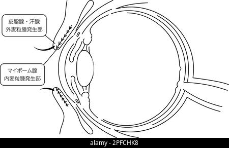 Illustration médicale, dessin anatomique du site d'origine de la maladie oculaire et de la mononucléose - Traduction: Glandes sébacées et sudoripares externe mal Illustration de Vecteur