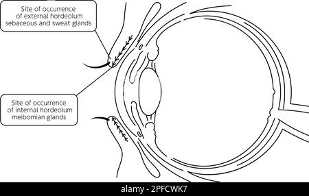 Illustration médicale, dessin anatomique du site d'origine de la maladie oculaire et de la mononucléose, Illustration vectorielle Illustration de Vecteur