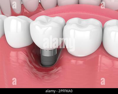 3d rendu de la mâchoire humaine avec la maladie de péri implantis sur fond blanc Banque D'Images