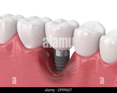 3d rendu de la mâchoire humaine avec la maladie de péri implantis sur fond blanc Banque D'Images